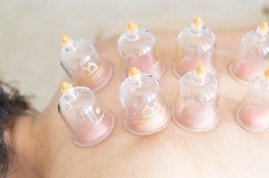 Acupuncture/Pricing. Cupping