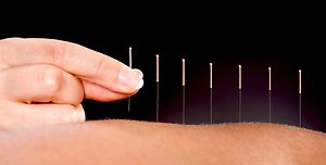 Acupuncture/Pricing. Needles 